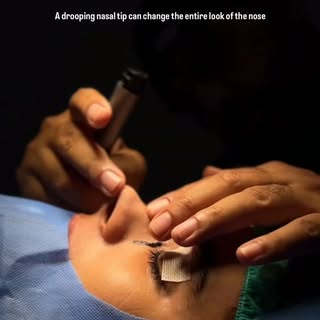 Correcting a Drooping Nasal Tip 👃🏻
.
.
.
#drhusnainkhan 
.
#plasticsurgery 
.
#albucasisclinic 
.
