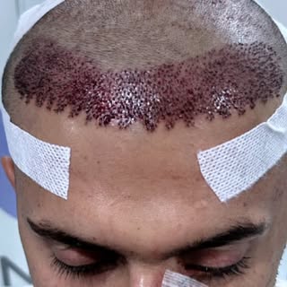 #beardtransplant #HairTransplant #viralreels #foryou #plasticsurgery