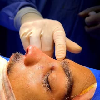 #Rhinoplasty #foryou #viral #trending #fyp