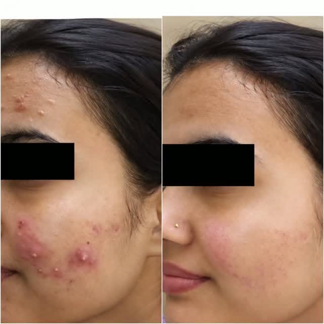 Sharing a real patient acne before and after from Dinaaz Hair & Skin Clinic, Bangalore, with the pat