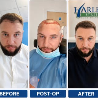 From hairline planning ➜ post-op ➜ final result.

This is what a proper hair transplant journey can 