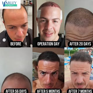 From thinning hair to a stronger, fuller-looking hairline — this is the kind of progress patients wa
