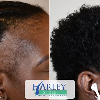 This transformation shows what a carefully planned female hairline restoration can do — soft, natura