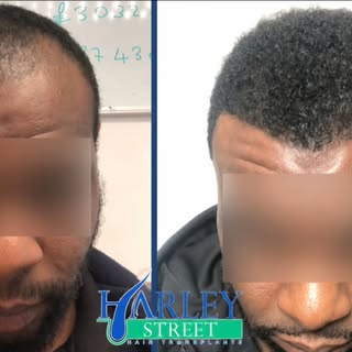 A hairline can change the whole frame of the face.

This result shows what careful planning can achi