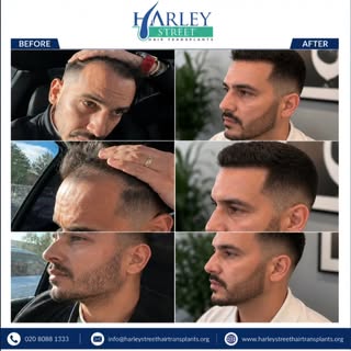 This patient wanted to improve both his hairline and beard density, creating a stronger, more youthf