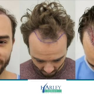 Jack P. Shepherd’s latest hair transplant has got people talking — and it shows how normal hair rest