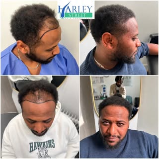 Stronger hairline. Improved density. A natural finish. 

This transformation shows what careful plan
