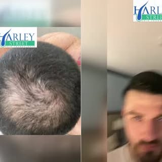 Crown Hair Transplant Before & After 

This patient came to us with noticeable thinning through the 