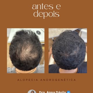 Mais um resultado incrível do nosso tratamento capilar! ✨

A região da coroa era o que mais incomoda