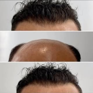 In the past, the only way to get a Farrell Hair Ultra Custom Hair System was to meet us in person. B