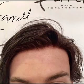 .
.
In the past, the only way to get a Farrell Hair Ultra Custom Hair System was to meet us in perso