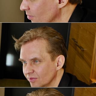 Farrell Hair Replacement addresses the needs of experienced hair system wearers who want to attain a