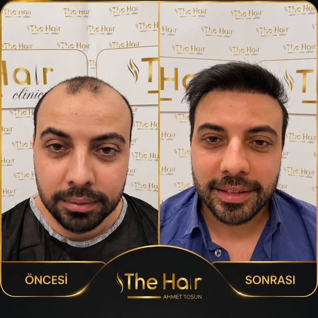 Bazı değişimler çok hissedilir, bazıları ise hayatınıza mutluluğu getirir. ✨

Danışanımızın saç ekim