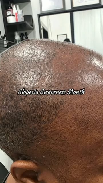 💚 September is Alopecia Awareness Month.

Alopecia doesn’t always look the same. It can show up as 