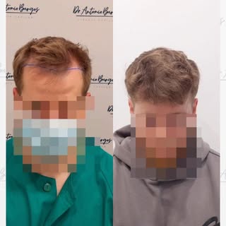 Me paso por aquí para dejaros un nuevo caso de injerto capilar y su evolución tras 12 meses 💫 Equip