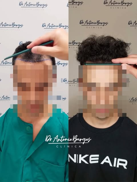 ¿Dirías que se ha injertado pelo?🤔

Descripción del caso:

EDAD: 29
SEXO: Masculino
ESCALA NW: III-