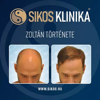 Zoltán páciensünk a videóban elmondja, hogy teljesen elégedett a műtéti ellátással, a körülményekkel