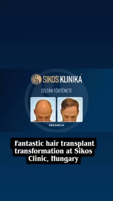 Zoltán páciensünk nagy örömmel számol be kiemelkedő hajbeültetés eredményéről és ajánlja Sikos Klini