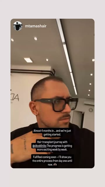 4 hónappal hajbeültetés után
4 months after Hair Transplant
#hairtransplant #HairTransplantRecovery 