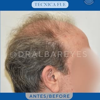 Nuestro paciente tomó la decisión de renovar su cabello y autoestima. 🔥🔥

Los resultados hablan po