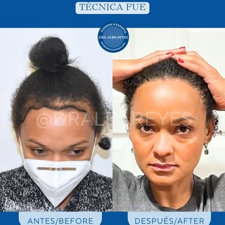 ¡Los resultados son espectaculares! 🌟👩‍🦰 Nuestra paciente ha transformado su look con un Long Hai