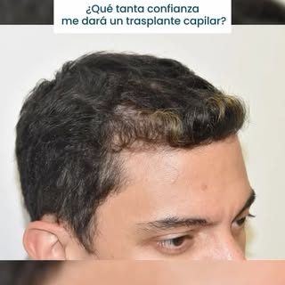 Un trasplante capilar no solo transforma tu apariencia, sino que también renueva tu confianza. 🌟

�