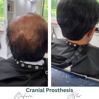This dapper chap waltzed in with his own cranial prosthesis (fancy term for a medical wig), and we w