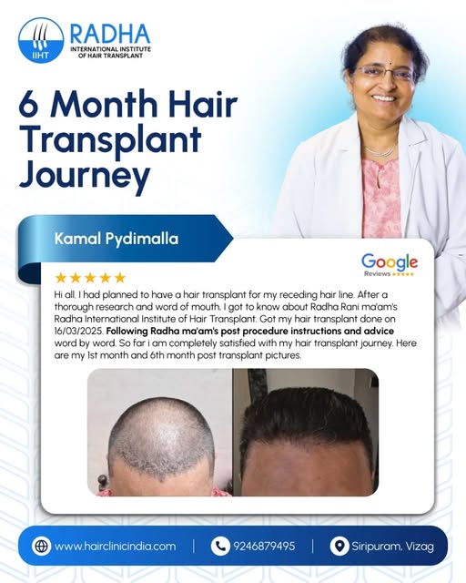 There’s something special about seeing a hair transplant journey unfold over time.

Real patient exp