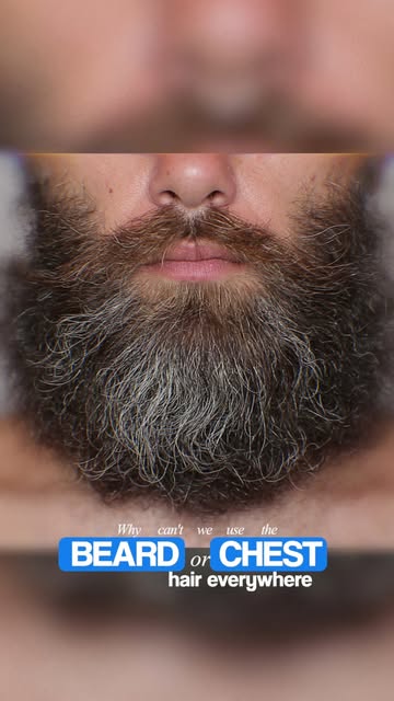 A lot of patients ask: If I don’t have enough donor hair on my scalp, why can’t we use beard or body