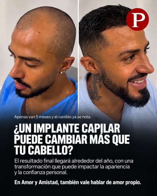 ¿Un implante capilar puede influir en la autoestima y el amor propio?

La pérdida de cabello no siem