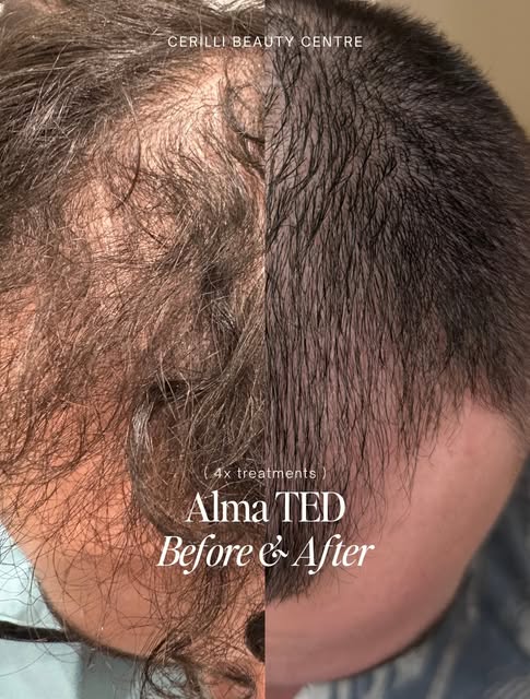 THIS is why we get so excited about Alma TED transformations.

because when you’re watching your den