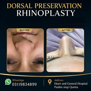 12th Day Post-Op | Dorsal Preservation Rhinoplasty | 100% Natural Dorsum + Refined Tip
Dorsal Preser