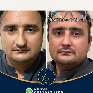 1-Month Septo-Rhinoplasty Result | Breathing Fixed + Natural Aesthetic
Is
Septo-Rhinoplasty by Dr No