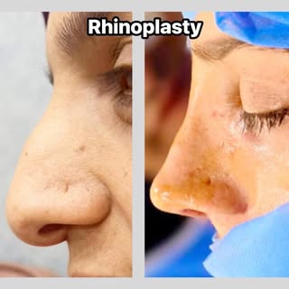 Septorhinoplasty | Hump + Crooked Nose Correction + Breathing Improvement

Septorhinoplasty by Dr No