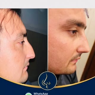 1-Month Septo-Rhinoplasty Result | Breathing Fixed + Natural Aesthetic


Septo-Rhinoplasty by Dr 