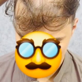 Bad Hair Transplant Repair Case | Straight Hairline + Poor Growth + Donor Damage

Hair Transplant Re