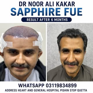 6-Month Result | Sapphire FUE Hair Transplant | Natural Density + Natural Hairline

Sapphire FUE Hai