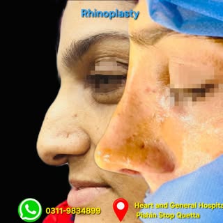Thick Skin Rhinoplasty Result | Straight Dorsum + Refined Tip + Natural Columella

Rhinoplasty for T