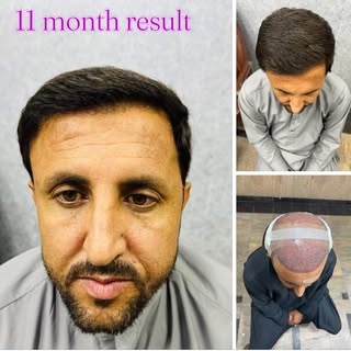11-Month Result | Sapphire FUE | Frontal + Crown Covered | Natural Hairline
@
Sapphire FUE Hair Tran
