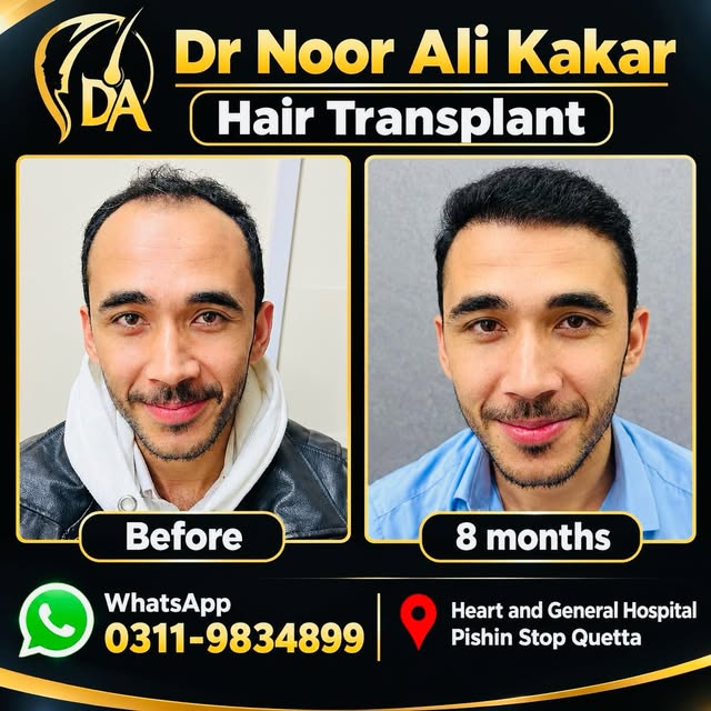 8 Month Result | Sapphire FUE Hair Transplant | Natural Hairline + Compact Density@
Sapphire FUE H