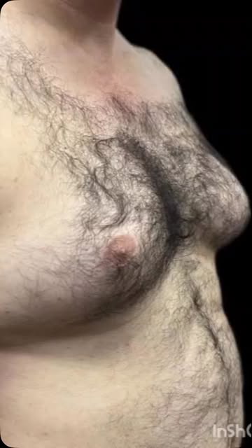 Huge Gynecomastia Corrected | Liposuction + Gland Excision | Attractive Male Chest

Gynecomastia Sur