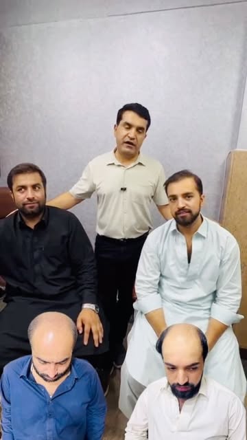 2 Brothers, Grade 7 Baldness, Poor Donor | Smart Planning = Dense Natural Result

Sapphire FUE Hair 