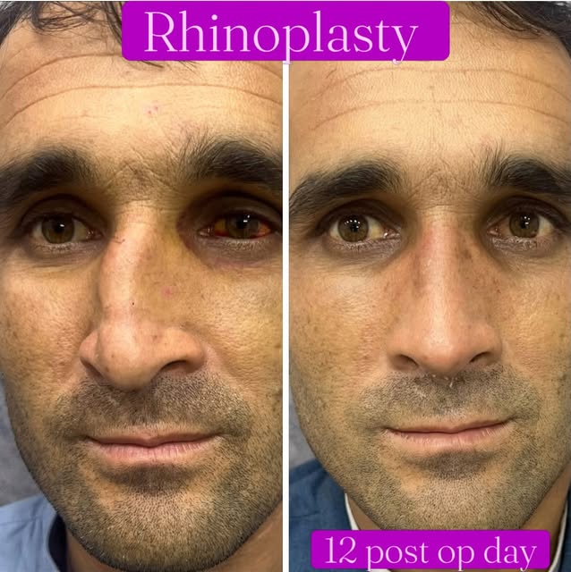 12 Days Result | Crooked Nose Fixed + Breathing Restored | Septo-Rhinoplasty

Septo-Rhinoplasty by D