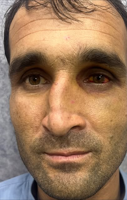 12 Days Result | Crooked Nose Fixed + Breathing Restored | Septo-Rhinoplasty

Septo-Rhinoplasty by D