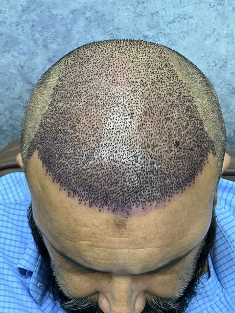 Good Donor = Full Coverage | Hairline to Crown with Equal Density

Sapphire FUE by Dr Noor Ali Kakar