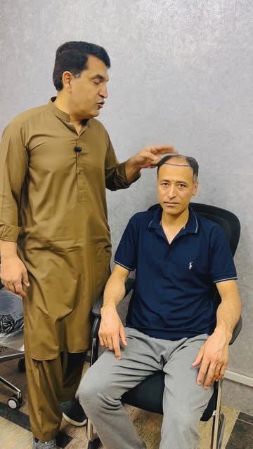 A Wise Decision | Mature Natural Hairline Instead of Teenage Hairline

Sapphire FUE by Dr Noor Ali K