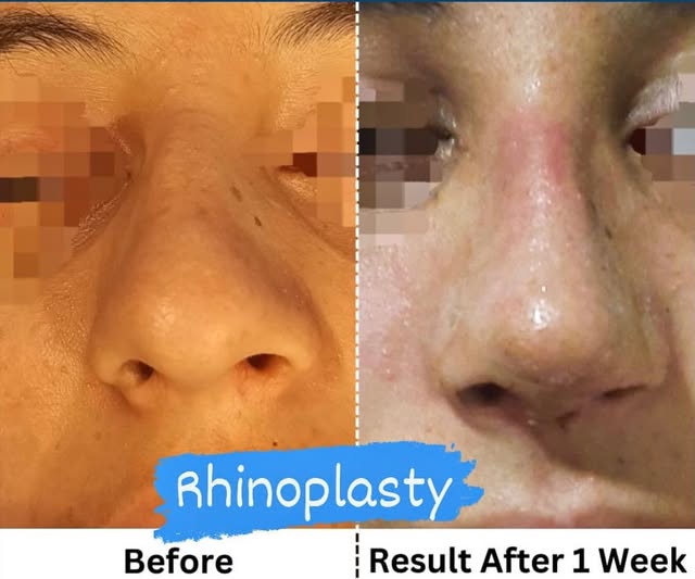 1 Week After Rhinoplasty | Balanced Natural Result For Her Face

Rhinoplasty by Dr Noor Ali Kakar

J