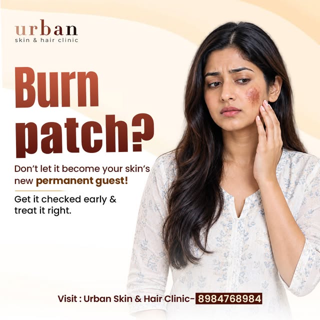 🔥 Burn Patch? Don’t Ignore It.

A burn may heal on the surface, but your skin can sometimes be left