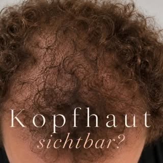 Haarausfall verändert oft mehr als nur die Haare.

Haarausfall ist mehr als nur ein optisches Proble