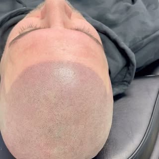 Once the redness settles down it’ll look completely natural and undetectable!